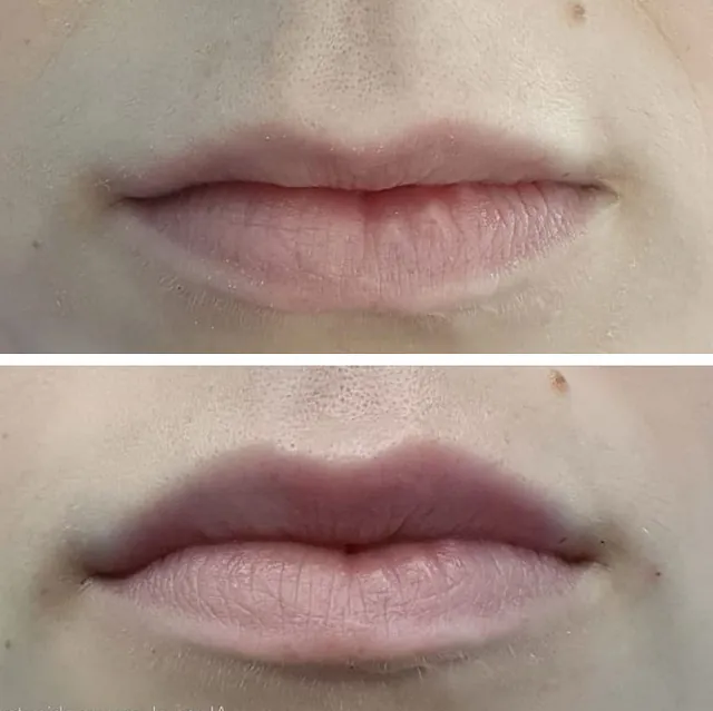  Medicina Estética Facial Sada relleno de labios