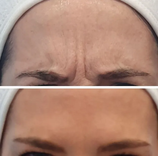  Medicina Estética Facial Sada neuromoduladores