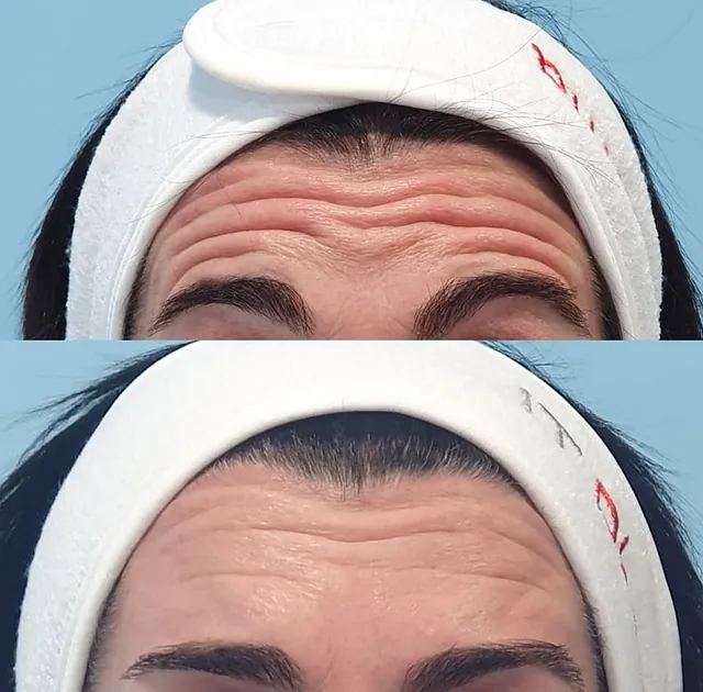  Medicina Estética Facial Sada antes y después de tratamiento 